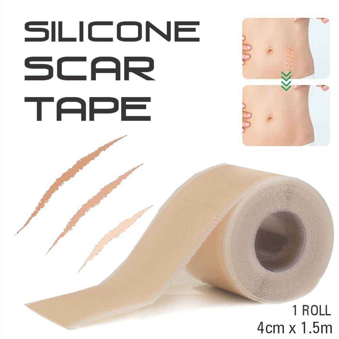 Bodyassist Silicone Scar Tape 4cm x 1.5m - STELLAR PHARMACY